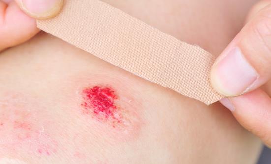 六種情況下嚴禁使用創可貼