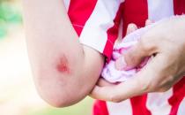 ?日常處理小傷口的正確步驟 科學處理傷口的原則