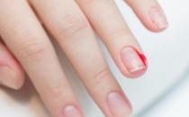 ?倒刺雖小處理不好會出大問題 預防倒刺有妙招