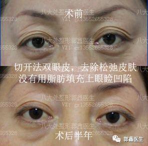 八大處整形郭鑫:上眼瞼凹陷脂肪填充圖片