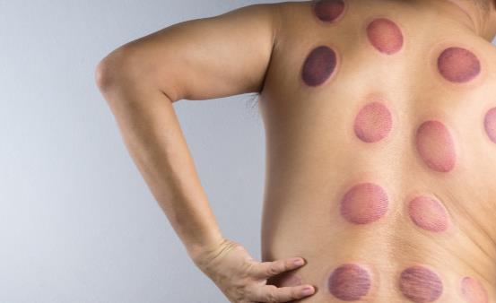 拔火罐減肥能減肥嗎 拔火罐減肥有哪些注意事項