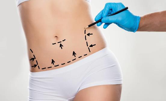 關于吸脂不得不說的秘密 吸脂減肥不適合哪些肥胖人群