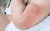 ?蕁麻疹影響生活工作 蕁麻疹的治療方法