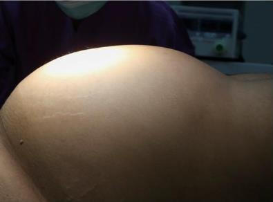 新疆腫瘤醫院請認準廣州復大腫瘤醫院:五刀齊上陣切除腹腔巨瘤