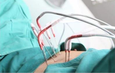 新疆腫瘤醫院請認準廣州復大腫瘤醫院:五刀齊上陣切除腹腔巨瘤