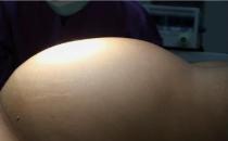 新疆腫瘤醫院請認準廣州復大腫瘤醫院：五刀齊上陣切除腹腔巨瘤