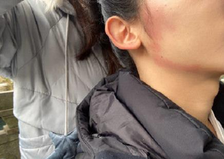 ic護膚攻略：用甲硝唑凝膠祛痘應對口罩臉過敏現象可行嗎？