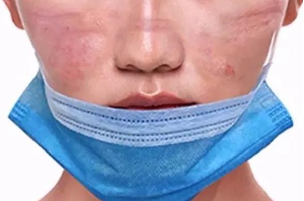 長期戴口罩痘痘叢生?有甲硝唑凝膠祛痘不用慌