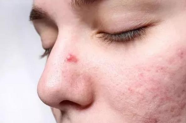 長期戴口罩痘痘叢生?有甲硝唑凝膠祛痘不用慌