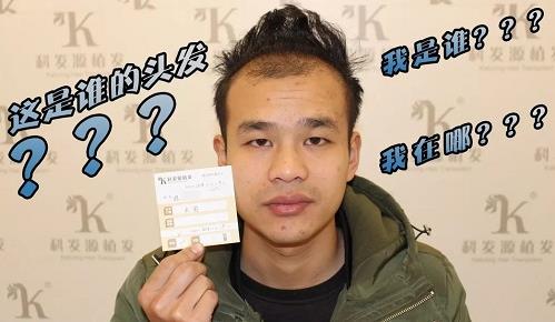 青島大麥微針植發(fā)2500毛囊單位,術(shù)后8個(gè)月恢復(fù)頭發(fā)濃密