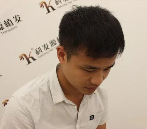 青島大麥微針植發(fā)2500毛囊單位,術(shù)后8個(gè)月恢復(fù)頭發(fā)濃密