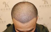 青島大麥微針植發2500毛囊單位，術后8個月恢復頭發濃密