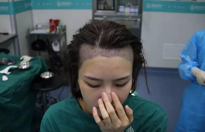 為什么植發(fā)效果相差半邊天?廣州青逸植發(fā)醫(yī)院專家透入原因居然是……